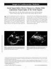 Research paper thumbnail of Atrial Septal Defect Device Closure in a Patient With Lipomatous Hypertrophy of the Atrial Septum