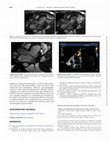 Research paper thumbnail of eComment. Pseudoaneurysm secondary to native valve endocarditis