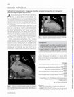 Research paper thumbnail of Left-ventricle leiomyosarcoma: imaging by multislices computed tomography with retrospective electrocardiogram-gated reconstruction