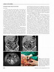 Research paper thumbnail of Tomographic findings in Meckel’s diverticulitis