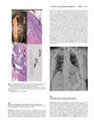 Research paper thumbnail of Phrenic Nerve Stimulation in an LVAD Patient with Severe Sleep Apnea