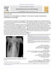 Research paper thumbnail of Fragment of a Hemodialysis Catheter in the Vena Cava—A Complication of Guidewire Exchange