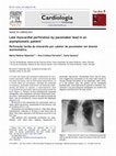 Research paper thumbnail of Late myocardial perforation by pacemaker lead in an asymptomatic patient