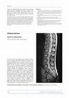 Research paper thumbnail of Spinal AV malformation