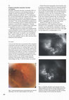 Research paper thumbnail of Peripheral idiopathic polypoidal choroidal vasculopathy