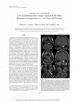 Research paper thumbnail of Imaging Case of the Month Left Cerebellopontine Angle Lipoma With Mild Brainstem Compression in a 13-Year-Old Female