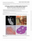 Research paper thumbnail of Cardioscopy resection of a multiple papillary fibroelastoma attached to the anterior interventricular septum