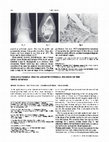 Research paper thumbnail of Coracoacromial pins to augment external fixation of the upper humerus