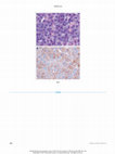 Research paper thumbnail of Unusual Presentations of Hematologic Malignancies