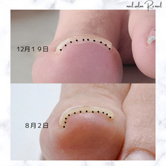 巻き爪ケア👣ビフォーアフター✨