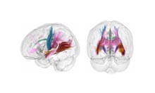 Two graphic illustrations of brain scans