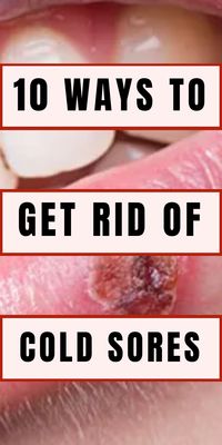 Here are 10 proven ways to help you eliminate cold sores fast and promote healing.