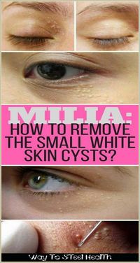 MILIA: HOW TO REMOVE THE SMALL WHITE SKIN CYSTS?