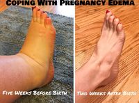 How to Manage Massive Pregnancy Swelling - Be Sure To See Your Doctor If You Have This Swelling — First Thyme Mom