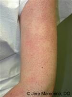 Helping keratosis pilaris with essential oils | dōTERRA Lifestyle