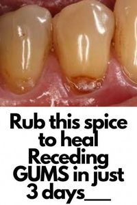 Reverse Cavities and Heal Tooth Decay in a Simple Steps