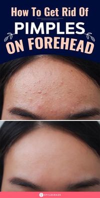 How To Get Rid Of Forehead Acne: You can resort to over-the-counter medication, depending on the severity of the acne on your forehead. If you have a mild case of acne, these natural remedies may help treat it. #Beauty #BeautyTips #Remedies #HomeRemedies #NaturalRemedies