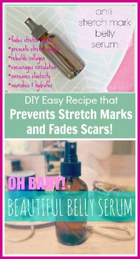 Stretch Mark Serum Recipe that works wonders at preventing stretch marks and even fades scars! www.PrimallyInspired.com