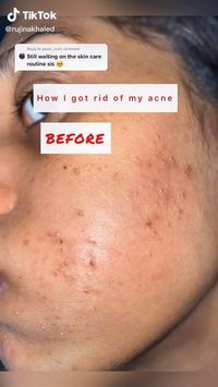 Here is how to get rid of acne fast with The Ordinary Skincare for Acne.