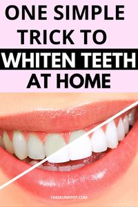 A popular home remedy for teeth whitening is the combination of baking soda and hydrogen peroxide.