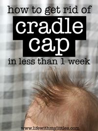 Not sure how to get rid of cradle cap? Here's an easy and inexpensive treatment that works in less than a week!