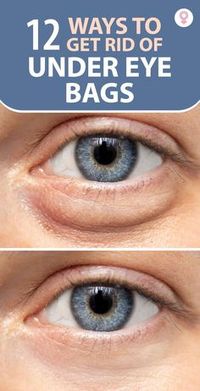 16 Ways To Get Rid Of Under Eye Bags: One of the most likely causes of under-eye bags is exhaustion. Other typical factors include stress and water retention. Getting rid of puffy eyes is a simple task that can be easily done at home.