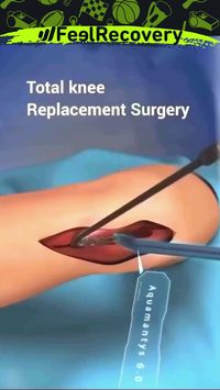 💥Total knee replacement surgery💥  📚Total knee replacement (TKR) or arthroplasty (TKA) refers to a procedure in which metal and plastic components are used to replace damaged knee joint structures (bone and cartilage).  🔎In the majority of cases, this damage is the result of degenerative osteoarthritis, which typically occurs in middle-aged and older adults. However, rheumatoid and post-traumatic arthritis can also be associated with joint degeneration and knee replacement.