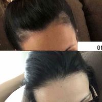 This girl listened to her gut. Read her testimony: . . Thankful I have my hairline back 🙌😱🤣😍 5 months of exclusively using Monat and I’m super thankful I listened to my gut and not all the naysayers I had in my ear!! Products I use: Renew Shampoo Revitalize Conditioner, Oil treatments Weekly/Sometimes twice a week and Intense Repair Treatment Spray among my hairline! . . . Email me at flockslovelylocks@gmail.com or shop link.