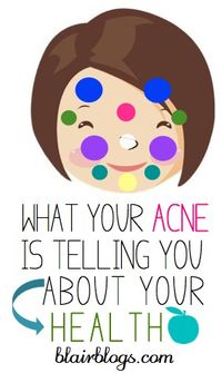 I had no idea that the location of facial acne is indicative of different health problems! This post helps to self-diagnose and cure acne.