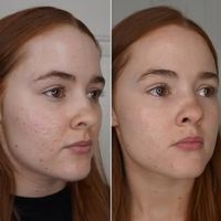 Murad InvisiScar Resurfacing Treatment: A breakthrough resurfacing treatment for acne scars (old and new) that visibly minimizes size, depth, and color in as little as eight weeks.