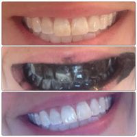 Why have I never known this before? 1/2 capsule of activated charcoal break and put on toothbrush or scrub with finger. Leave on teeth for 5 minutes.