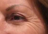 Crow’s feet are best treated with a wrinkle relaxer, however, some people require fillers in the area to support the smile muscles and restore lost volume. To reduce crows feet visit https://naturallooks.com.au/services/wrinkle-muscle-relaxers/crows-feet/