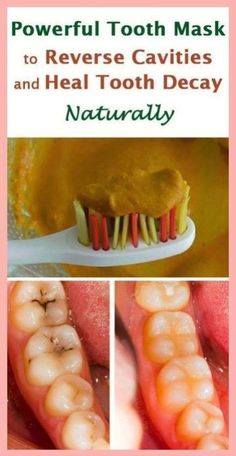 Rub this spice to Rebuild Your Teeth and Gums And Get Rid of Tooth Decay😃 Reverse Cavities Naturally, Teeth Hacks, Reverse Cavities, Heal Cavities, Dental Health Care, Teeth Health, Receding Gums, Diy Remedies, Natural Health Tips