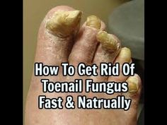 Fungal Nail Infections How To Get Rid Of Toenail Fungus Fast, Thick Toenail Remedy How To Get Rid, Toe Nail Fungal Infection, Toenail Problems, Bad Nails, Long Toenails