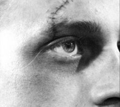 a man with stitches on his face and eye