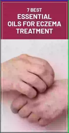 There are many different essential oils that can be used to treat eczema, but some of the most effective include chamomile oil, eucalyptus oil, geranium oil, clove oil, tea tree oil, lavender oil and frankincense oil. Chamomile Oil, Clove Oil, Frankincense Oil, Geranium Oil, Eucalyptus Oil, Diy Skincare, Best Essential Oils, Tree Oil, Lavender Oil