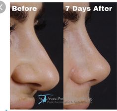 Bulbous Tip Rhinoplasty, Tip Rhinoplasty, Bulbous Nose, Pretty Nose, Perfect Nose, Nose Surgery, Small Nose