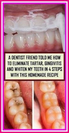 Teeth Health, Homemade Recipe, Natural Health Remedies, Personal Health, Health And Beauty Tips, Dental Health, Health Remedies, Herbal Remedies, Natural Health