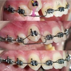 Dental Orthodontics, Medical School Life, My Future Job, Dental Braces, Flyer Design Inspiration, Dental Assistant, Oral Care, Braces, Flyer Design