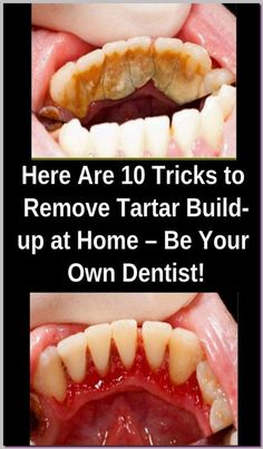 BE YOUR OWN DENTIST! HERE ARE TRICKS TO REMOVE TARTAR BUILDUP AT HOME Nice Teeth, Healthy Smile