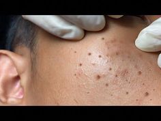 Acne treatment Huong Da Nang#acne#huongbeauty#Make your Acne Treatment Huong Da Nang | 447 # acne 2022 Clean Pores Videos, Popping Blackheads Youtube Videos, Zit Remedy, Covering Acne, Blackheads On Face, Cystic Pimple, Pimples Under The Skin, Acne Prone Skin Care, Zit Popping Videos