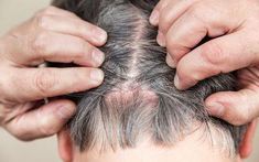 Skin lesions are abnormal changes in any area of skin. They may be primary or secondary, benign or cancerous. Here are 20 common ones with photos. Scalp Scabs, Sores On Scalp, Head Louse, Itchy Scalp, Dry Scalp, Hair Follicle, Dandruff, Hair Skin