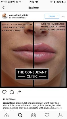 Lips Injections Shapes, 1ml Lip Filler