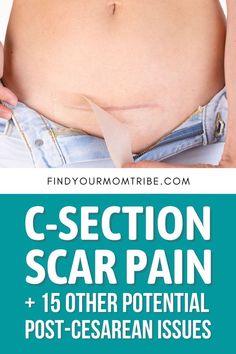 Cesarian Section, C Section Scar, C Section Scars, Scar Reduction, Reduction Surgery, Abdominal Surgery, Postpartum Care, C Section, Scar Tissue