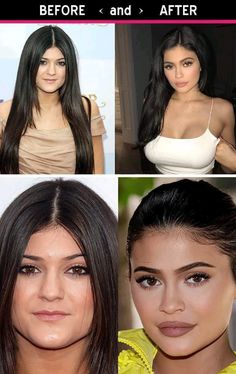 Kylie Jenner Surgery, Kylie Jenner Plastic Surgery, Plastic Surgery Pictures, Face Plastic Surgery, Celebrity Surgery, Cheek Implants, Face Transformation, Plastic Surgery Fail, Plastic Surgery Gone Wrong