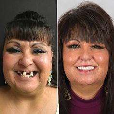 Implantes dentales (antes y después)  --  #implantesdentales #clinicadental #odontología Dental Implants Cost, Partial Dentures, Dental Veneers, Anatomy Study, Dentures, Dental Implants, Anatomy, Marketing, Quick Saves