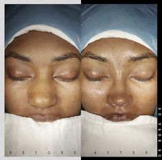 Black Nose Job, Ethnic Rhinoplasty African Americans, Black Rhinoplasty, Nose Job Black Women, Perfect Nose Rhinoplasty, Nose Job Inspo