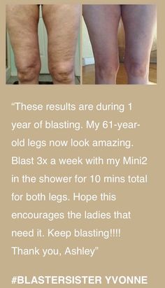 the before and after pictures of an old woman's legs, showing how to get rid