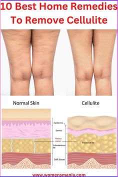 Here are the 10 simple and best home remedies to remove cellulite. Oak Cabinet, Health Podcast, Learn Yoga, Health Planner, Cabinet Makeover, Bodyweight Workout Beginner, Skin Remedies, Loose Skin, Normal Skin