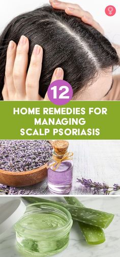 12 Home Remedies For Managing Scalp Psoriasis: It is often mistakenly thought that psoriasis only affects the skin on your arms, legs, or back. On the contrary, psoriasis can appear on any part of the body, including the scalp. And, like other common skin conditions, home remedies for scalp psoriasis can be effective in helping you treat the problem if you know how to apply them correctly. Home Remedies, Hair Hair